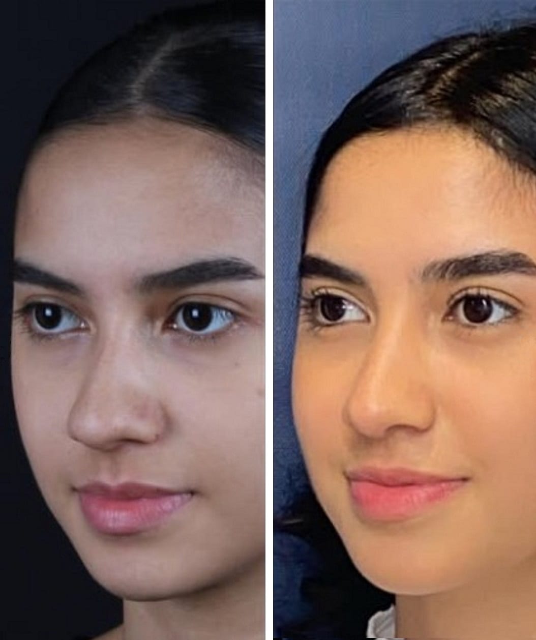 Rinoplastia caso 3 — antes y después
